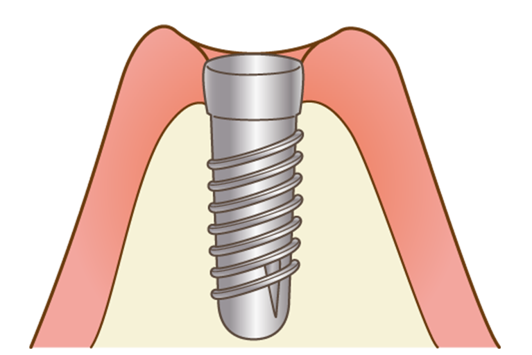 インプラント治療の一時手術