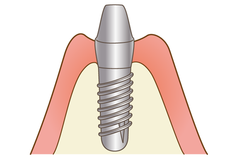 インプラント治療の二次手術