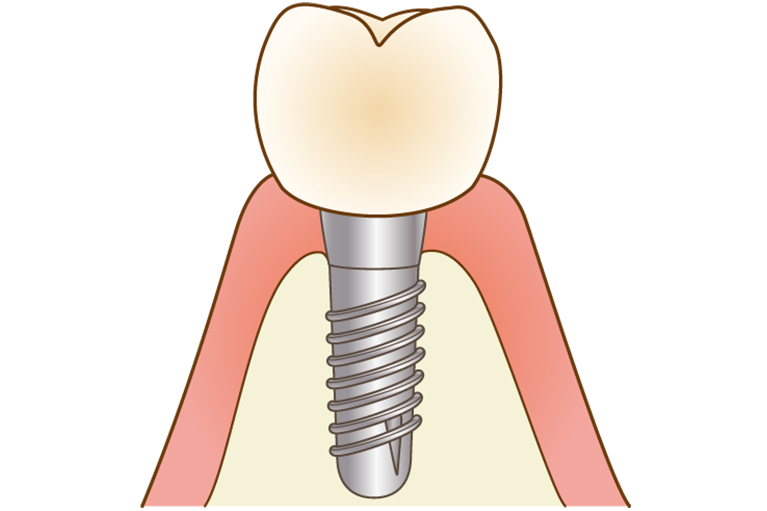 インプラント治療の完成
