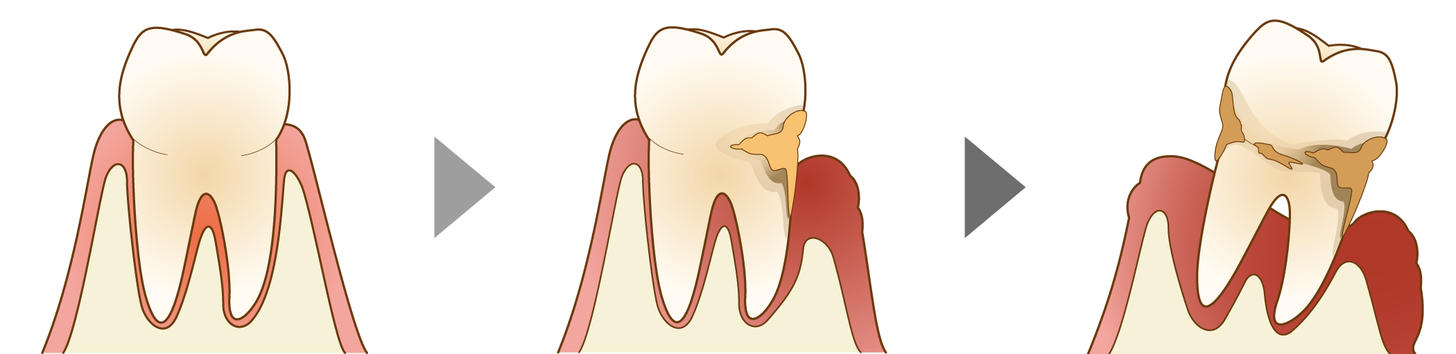 歯周病の進行
